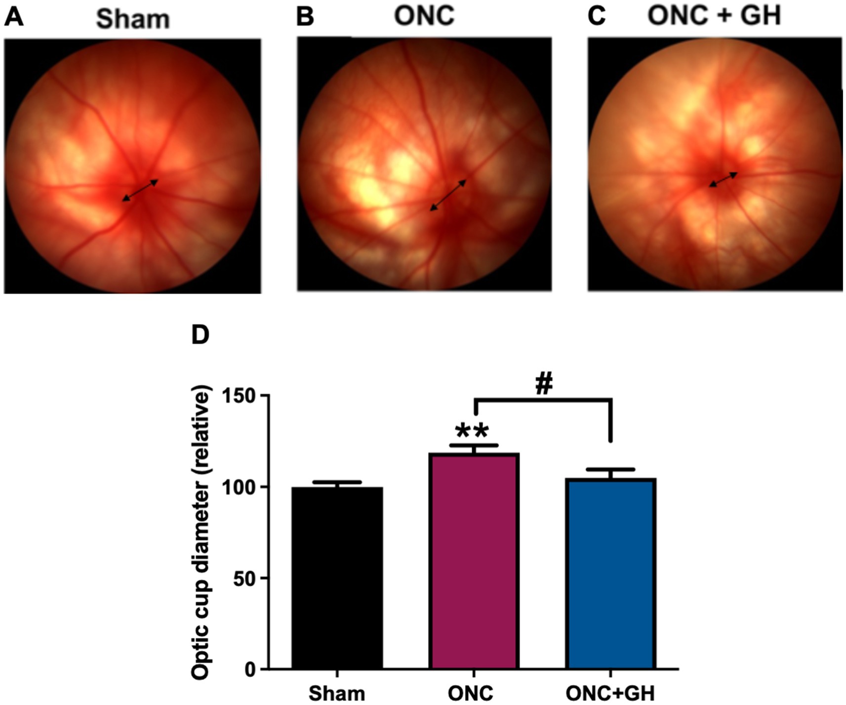 Three retinal fundus images labeled A (Sham), B (ONC), and C (ONC + GH) compare the optic cup appearance. Panel D is a bar graph showing optic cup diameter. The ONC group shows a significant increase (indicated by **), while ONC + GH shows a moderate decrease (#), compared to ONC.