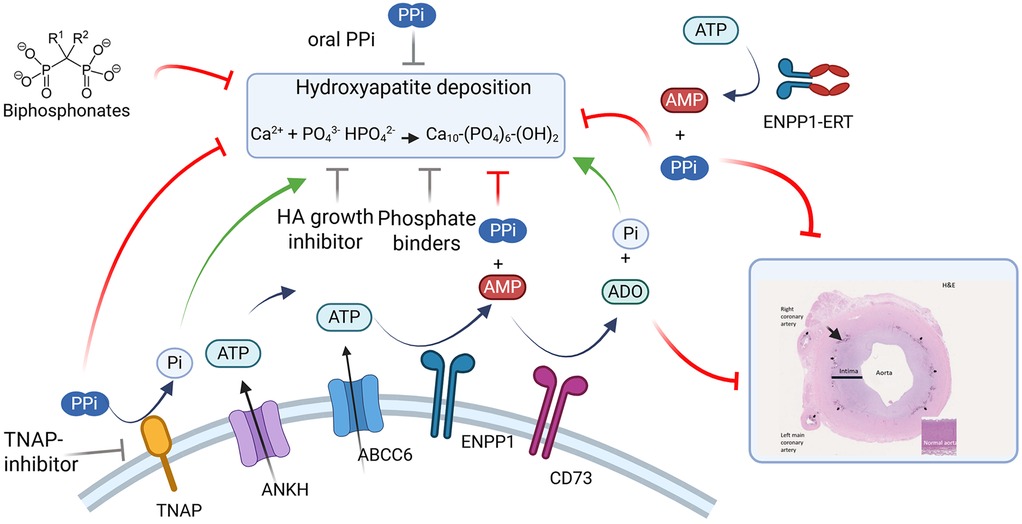Diagram illustrating the process of medial vascular calcification depicting the major protein enzymes and transporters including TNAP, ANKH, ABCC6, ENPP1, and CD73 that regulate the key molecules influencing mineralization including ATP (adenosine triphosphate), AMP (adenosine monophosphate), ADO (adenosine), PPi (pyrophosphate), and Pi (phosphate). Depicted are the various therapeutics discussed in the article and their points of influence on the pathway. Features a histological image of an aorta cross- section from an ENPP1 Deficient patient, highlighting medial calcification and intimal thickening. Inset images from Ferreira C, et al. (22).