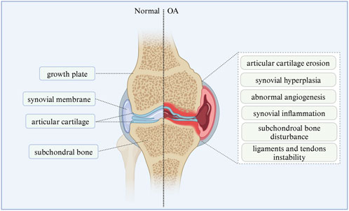Illustration comparing a normal joint and one with osteoarthritis (OA). The left side shows a healthy structure, labeled growth plate, synovial membrane, articular cartilage, and subchondral bone. The right side, representing OA, highlights conditions like articular cartilage erosion, synovial hyperplasia, abnormal angiogenesis, synovial inflammation, subchondral bone disturbance, and ligaments and tendons instability.