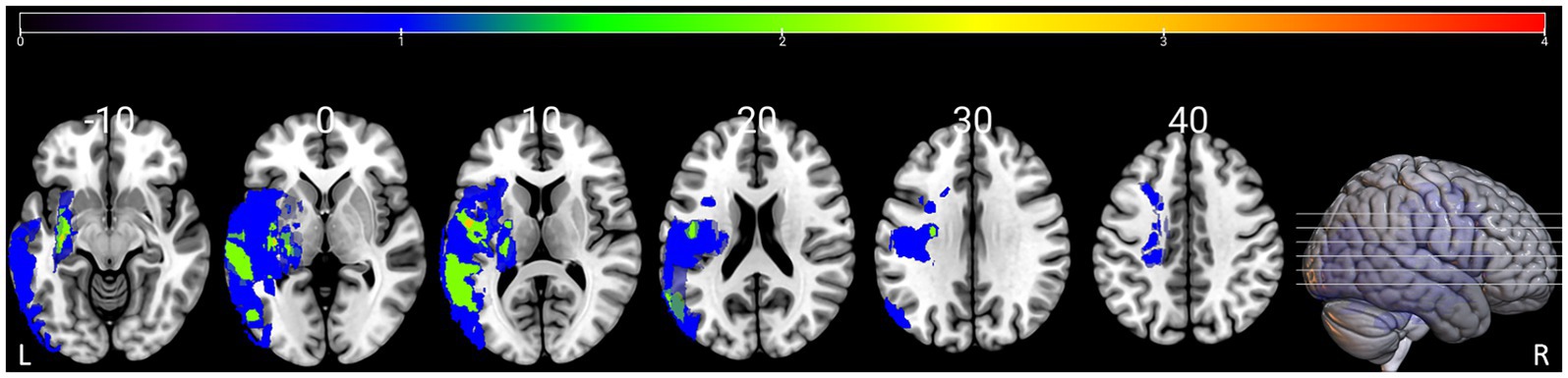Coronal MRI slices of a human brain with colored overlays indicating activity levels from blue to red. The slices, numbered from -10 to 40, show varying patterns of activated regions. A color scale ranging from blue to red represents the intensity levels. A lateral view of the brain is on the right, showing slice positions.