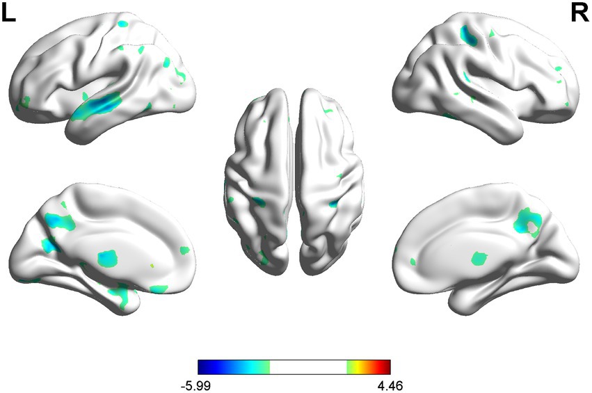 Brain scans showing five 3D views of the brain with highlighted areas in green and blue. The views include lateral, medial, and dorsal perspectives. A color scale below ranges from blue (-5.99) to red (4.46).