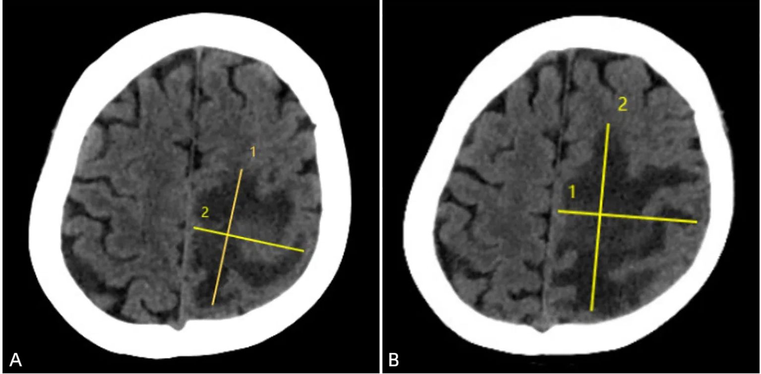 Two CT scan images labeled A and B show cross-sectional views of the brain with yellow lines indicating measurements. Image A has two intersecting lines labeled 1 and 2, while in Image B, the lines are reversed with 1 running vertically and 2 horizontally. The scans depict symmetrical brain structures with clear distinction between gray and white matter.