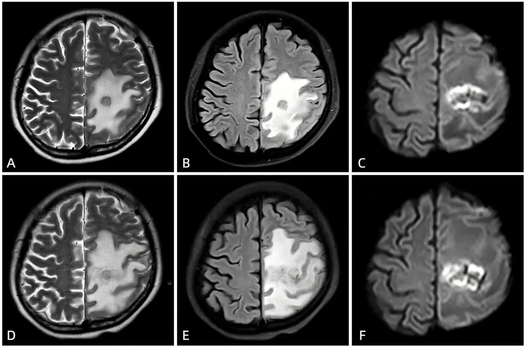 MRI brain scans in two rows. Images A, B, C, D, E, and F depict different stages or aspects of an abnormality in the brain’s right hemisphere, with variations in brightness and contrast highlighting the affected area. Each image appears to show different MRI techniques or sequences, reflecting changes or lesions in the tissue.