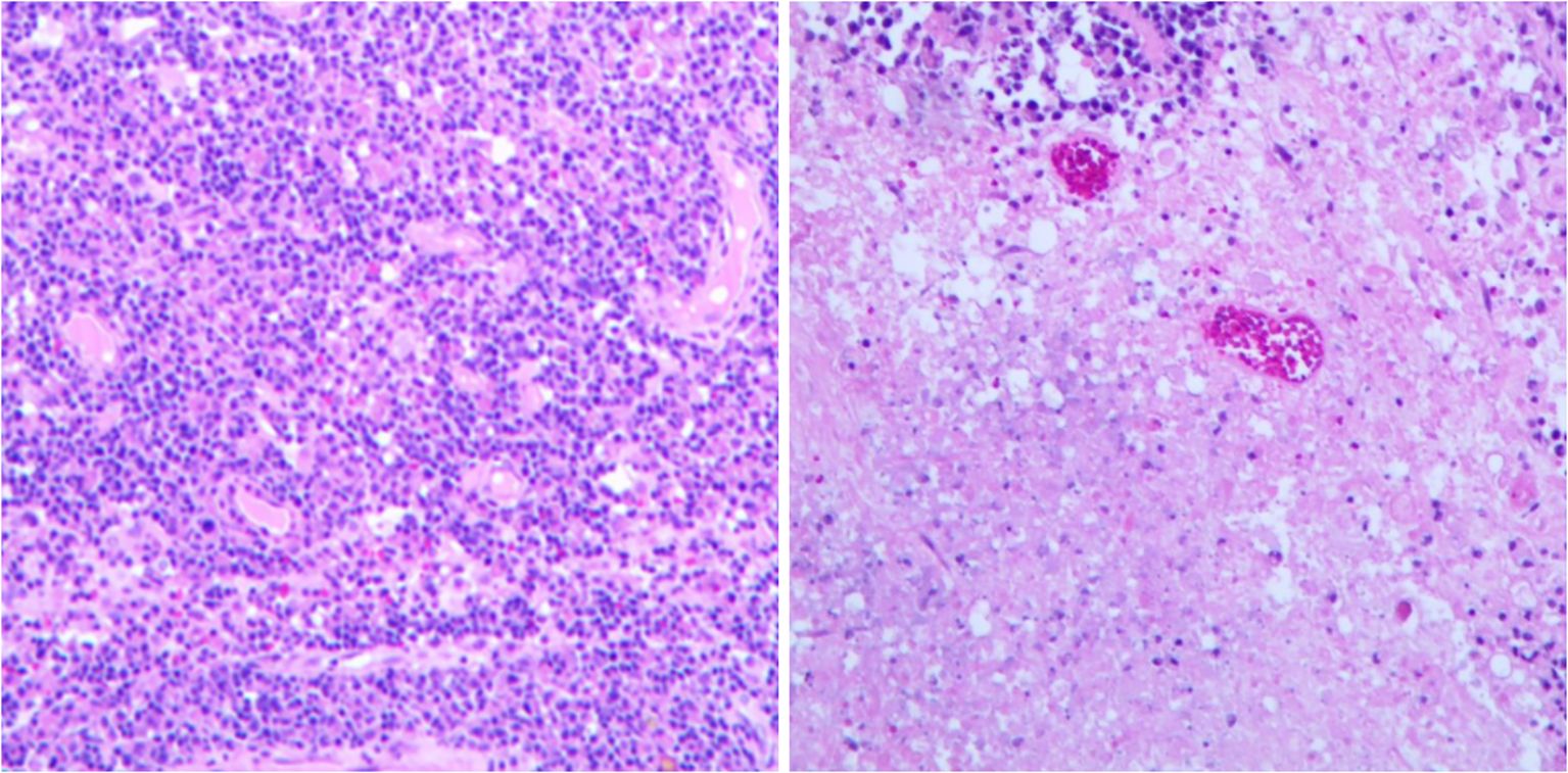 Two microscopic images showing tissue samples. The left image displays densely packed purple cells, indicating active cellular presence. The right image shows a more sparse distribution with two darker pink features, suggesting different staining or tissue condition.