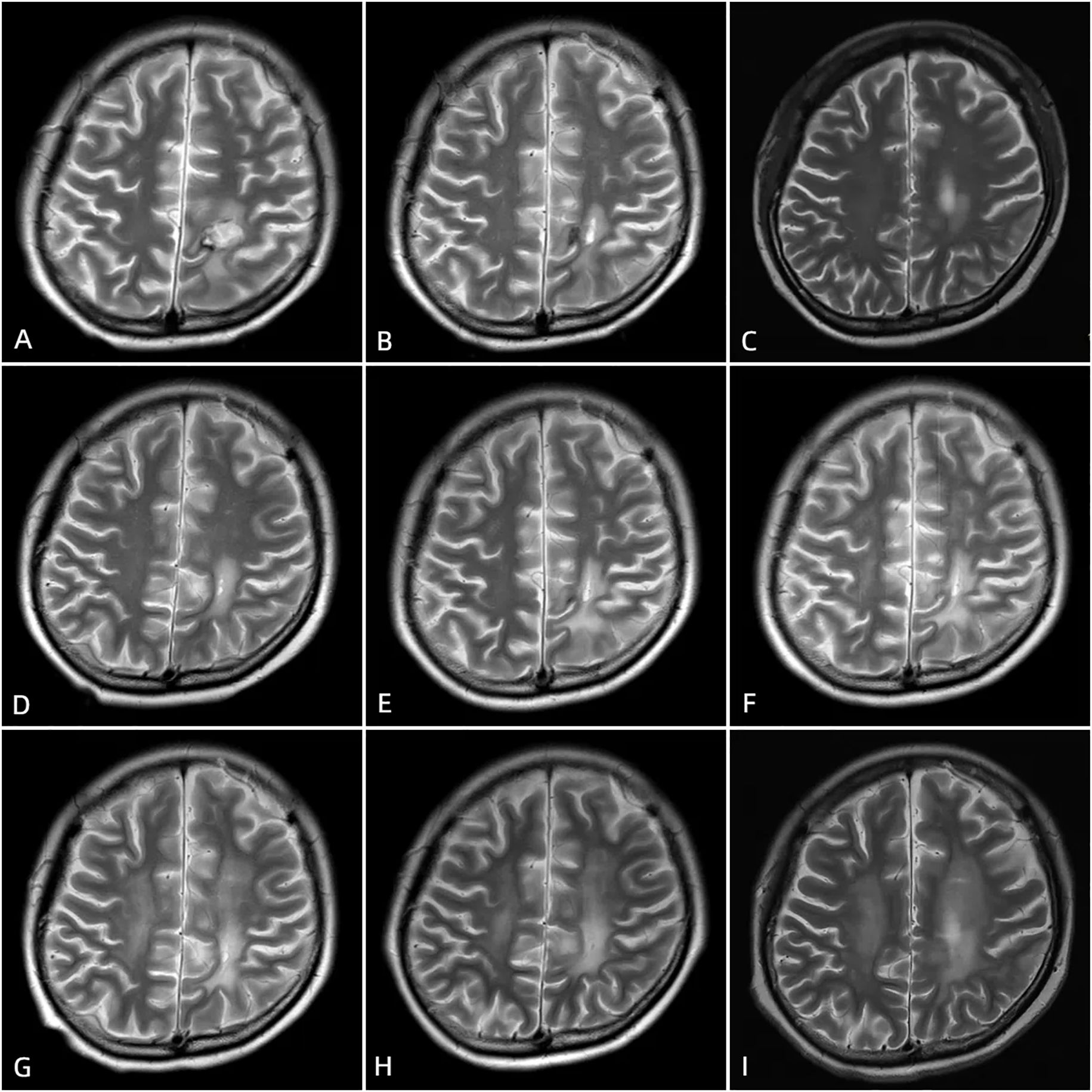 Nine panel grid of MRI brain scans labeled A to I, showing axial views. Each scan highlights varying degrees of brain structure visibility and contrast, emphasizing the cerebral cortex's gyri and sulci patterns.