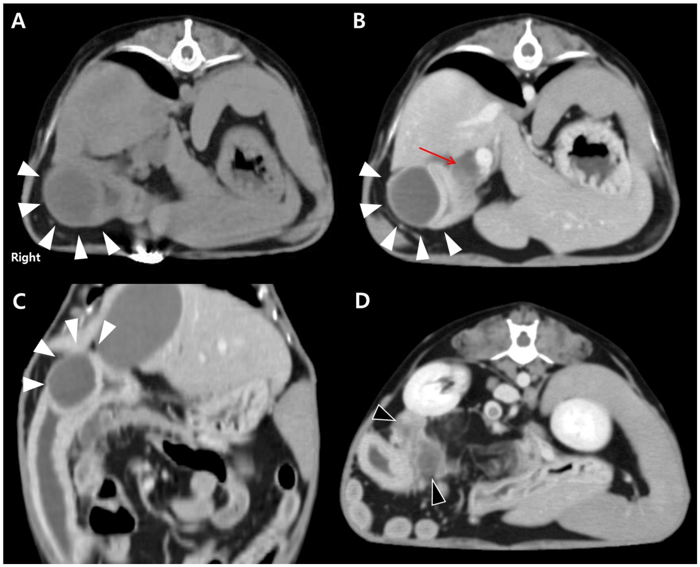 CT images show an intramural duodenal abscess with changes in the biliary system and pancreas. Panel A, a transverse pre-contrast image, depicts a round fluid-filled lesion in the proximal descending duodenum, indicated by white arrowheads. Panel B, a transverse post-contrast image, shows rim enhancement of the lesion with central low attenuation and marked dilation of the bile ducts, indicated by a red arrow. Panel C, a dorsal post-contrast view, outlines the lesion near the major duodenal papilla with white arrowheads. Panel D, a transverse post-contrast image, demonstrates diffuse low attenuation in the pancreas with black arrowheads.