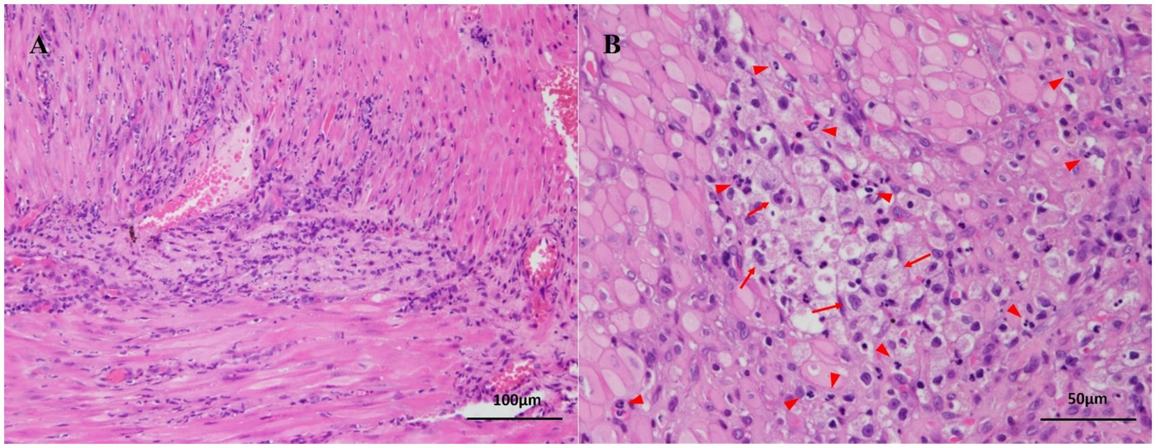 Histopathological images of the duodenal wall show features of an intramural abscess. Panel A demonstrates diffuse infiltration of numerous neutrophils within the muscular layer without involvement of the mucosa or serosa. No neoplastic cells or vascular thrombosis are observed. Panel B provides a higher-magnification view showing chronic inflammation with abundant neutrophils marked by red arrowheads and macrophages containing phagocytized neutrophils marked by red arrows. A small amount of necrotic debris is present in the central region of the lesion. Sections are stained with hematoxylin and eosin, with scale bars of 100 micrometers in Panel A and 50 micrometers in Panel B.
