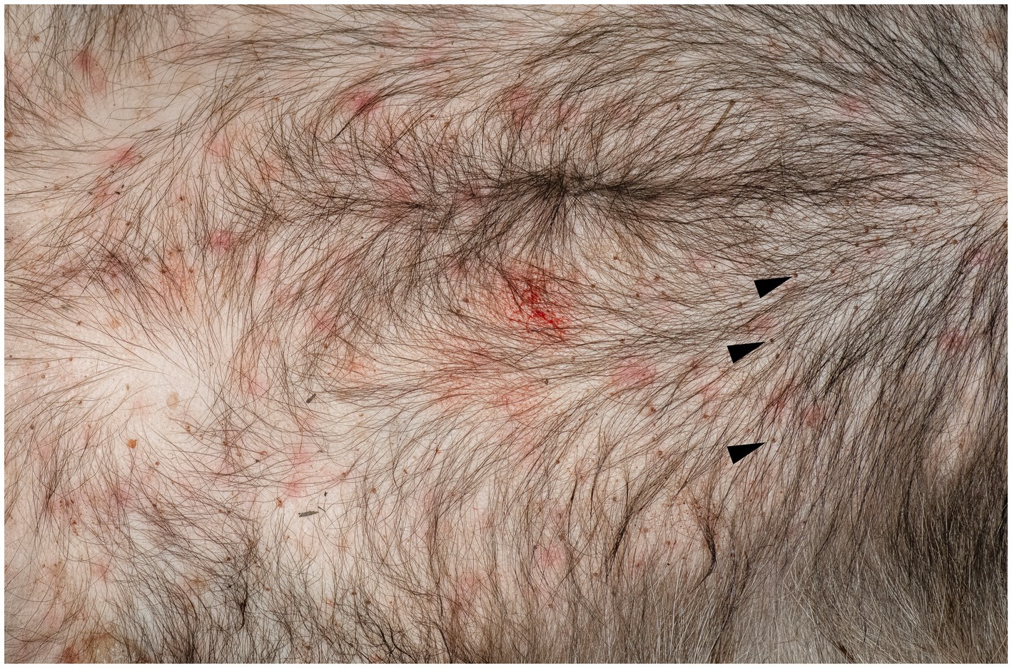 Close-up of skin showing hair and numerous small, red bumps scattered across the surface. Some areas appear redder with slight irritation. Triangular markers point to specific spots.
