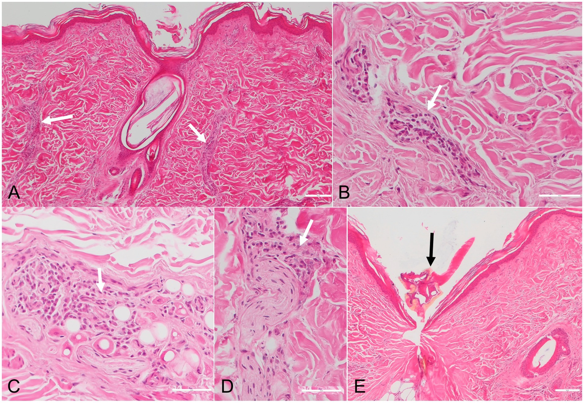 Histological images labeled A to E showing a skin biopsy with inflammatory cell infiltration and structural changes. Arrows indicate key features such as cell clusters and tissue alterations. The images highlight variations in cell density and arrangement across different sections.