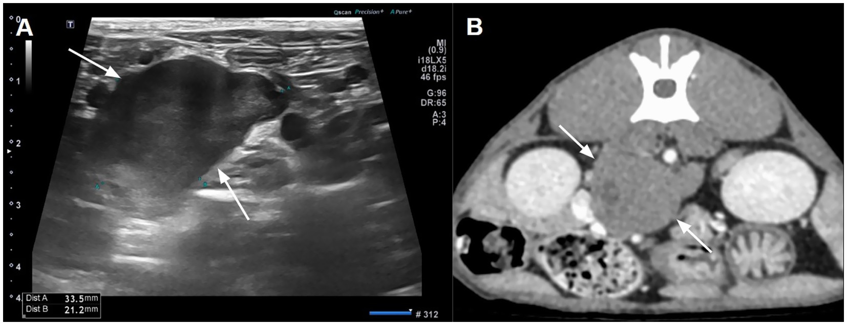 Panel A shows an ultrasound image with arrows pointing to a large, irregular mass. Panel B presents a CT scan with arrows indicating a similar mass in the abdominal region, suggesting a possible abnormality or lesion.