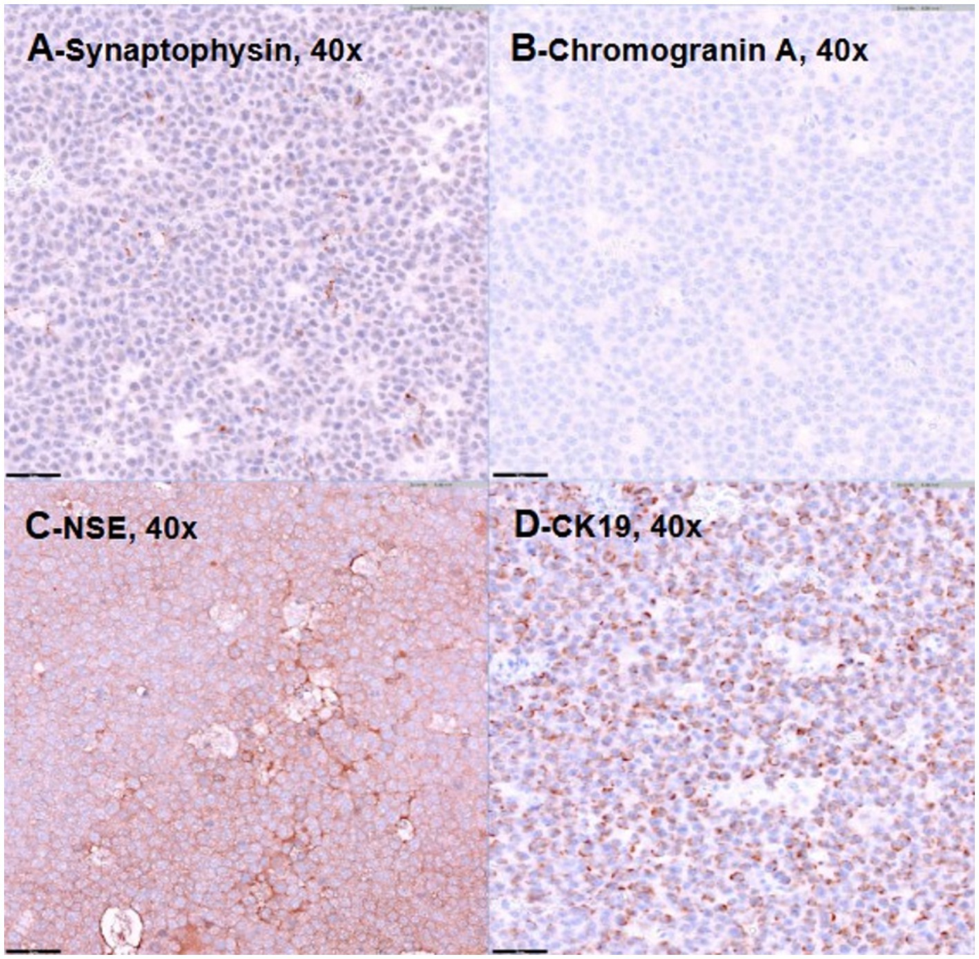 Histological image showing four panels of tissue staining at 40x magnification. Panel A shows Synaptophysin staining, Panel B shows Chromogranin A, Panel C displays NSE, and Panel D shows CK19. Differences in staining intensity and pattern are visible in each panel.