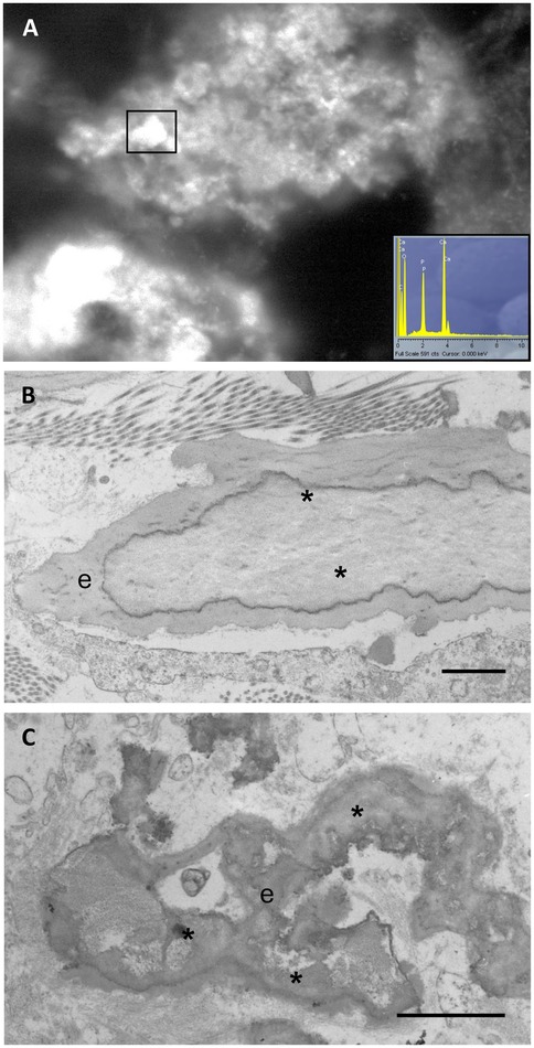 Three-part microscopic image series: A: wet scanning electron microscopy showing bright calcified areas; inset with yellow spectral peaks indicates elemental composition with high calcium and phosphorus. B and C: Electron micrographs of a vessel wall with elastic fibres (e); asterisks denote calcified regions.