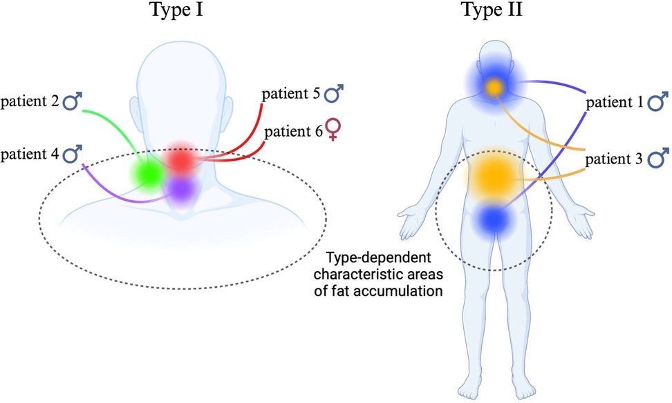 Illustration showing type-dependent characteristic areas of fat accumulation. Type I, on the left, focuses on the neck and upper back, linked to patients 2, 4, 5, and 6. Type II, on the right, highlights the neck, chest, and abdomen, related to patients 1 and 3. Different colored lines connect patient numbers to specific areas.