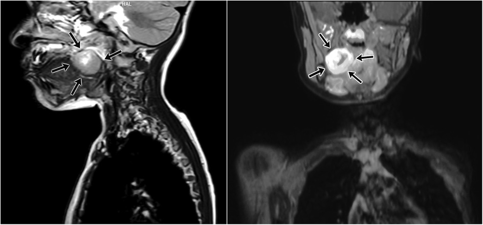 MRI scans in sagittal and coronal views showing a tumor in the jaw area, highlighted by arrows. The images reveal its position relative to surrounding tissues.