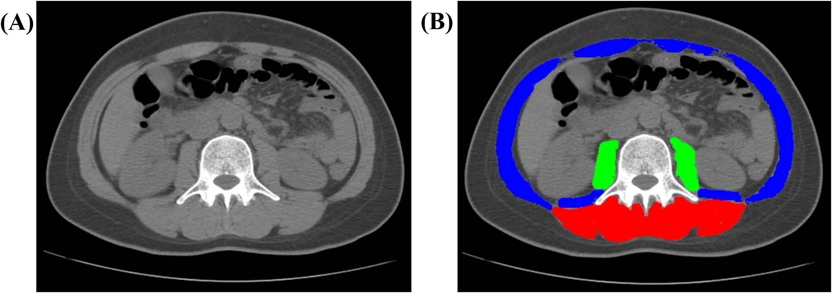 CT scans of an abdominal cross-section. Image A shows a standard grayscale scan. Image B highlights regions with colors: blue, green, and red, representing different tissue areas for analysis.