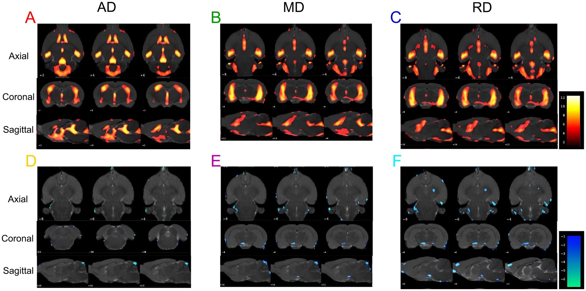 Brain imaging scans showing axial, coronal, and sagittal views across different conditions labeled AD, MD, and RD. Sections A, B, and C highlight areas in red and orange, indicating varying intensities. Sections D, E, and F display different brain regions with blue highlights. Included are color scales for intensity reference.