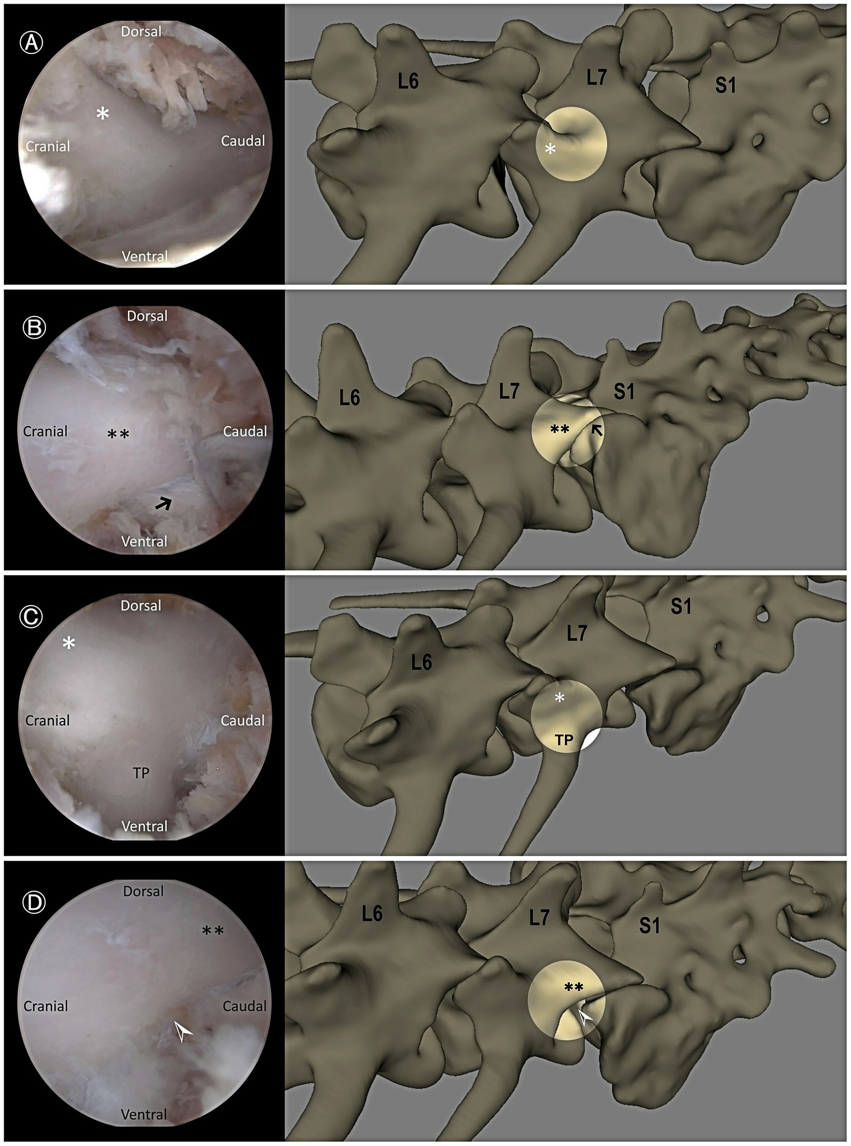 Four-panel image showing endoscopic and anatomical views of the L6, L7, and S1 vertebrae. Panel A: Endoscopic view with a white asterisk, anatomical view highlighting L7. Panel B: Endoscopic view with double asterisks and a black arrow; anatomical view highlights S1. Panel C: Endoscopic view with a white asterisk and