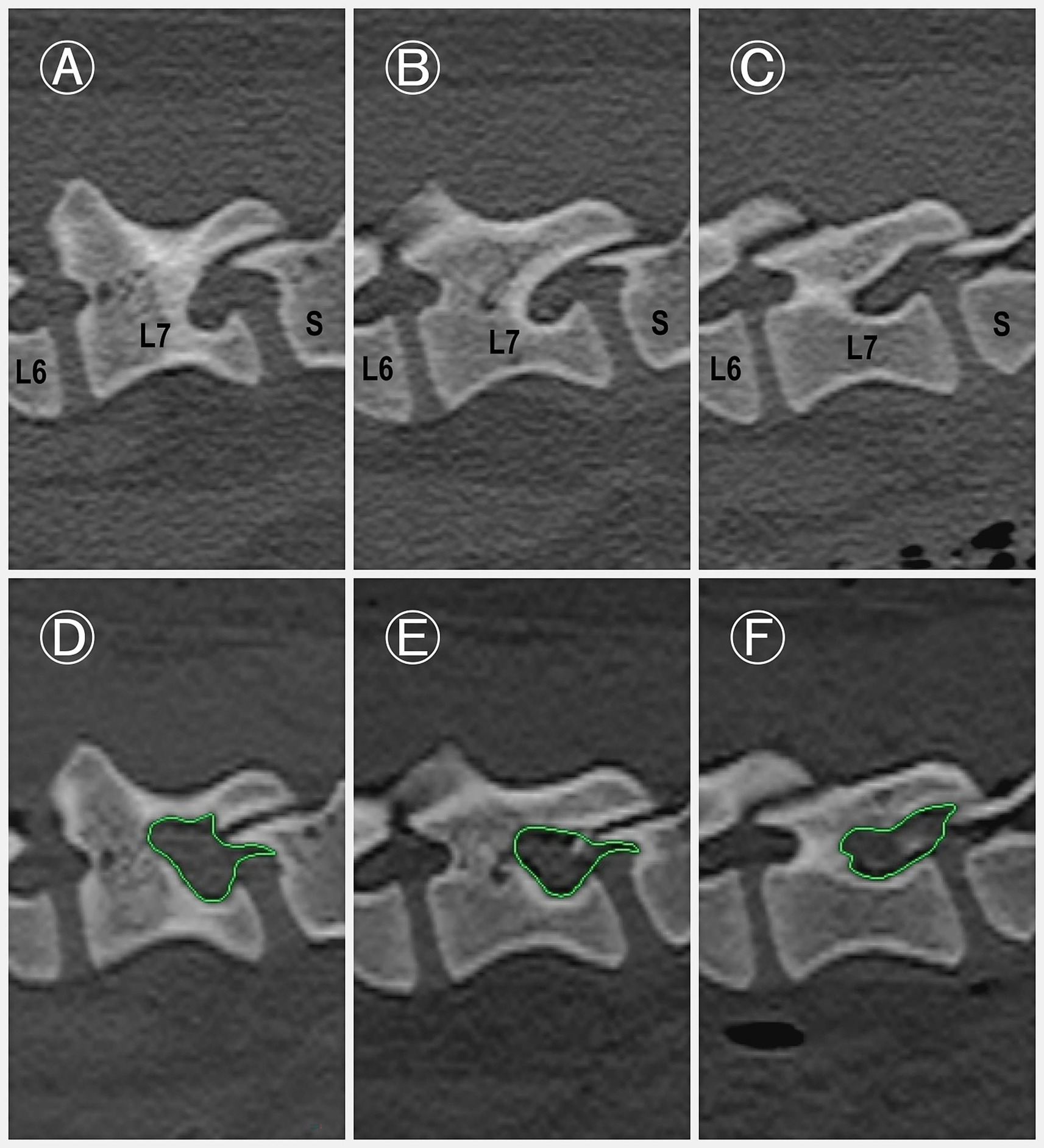 Six-panel medical image showing lateral views of vertebrae labeled L6, L7, and S. Panels A, B, and C display the vertebrae without outlines. Panels D, E, and F have green outlines indicating a specific area on the L7 vertebra. Each panel is marked with a letter from A to F.