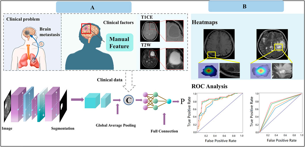 Diagram illustrating brain metastasis model development and application. Model construction involves clinical problem identification, manual feature extraction from brain images, clinical data processing, and neural network training. Model application includes heatmap analysis for brain images and ROC analysis for evaluating model performance, shown in graphs depicting true positive rates versus false positive rates.
