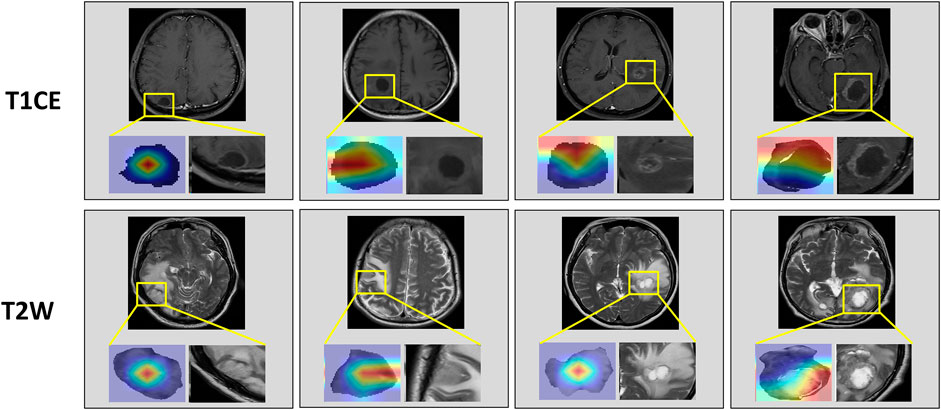 MRI scans showcase different brain images using T1CE and T2W sequences. Each panel highlights a specific area with a zoomed-in view that includes a color-coded representation of data alongside a grayscale image segment. The top row contains T1CE images, and the bottom row contains T2W images, with distinct details and patterns visible in each section.