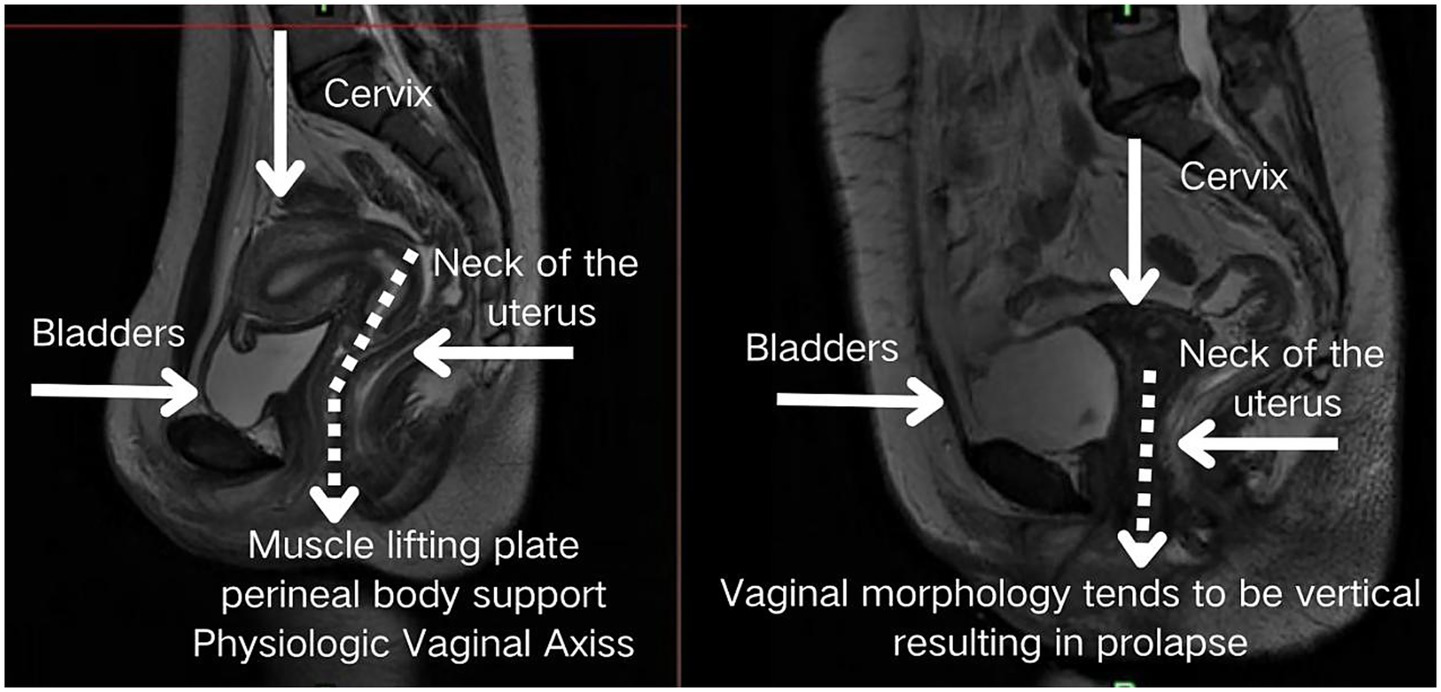 MRI scan comparison of pelvic anatomy. The left image shows the physiologic vaginal axis supported by the muscle lifting plate and perineal body, with labels for cervix, bladder, and neck of the uterus. The right image illustrates a more vertical vaginal morphology leading to prolapse, with similar anatomical labels.