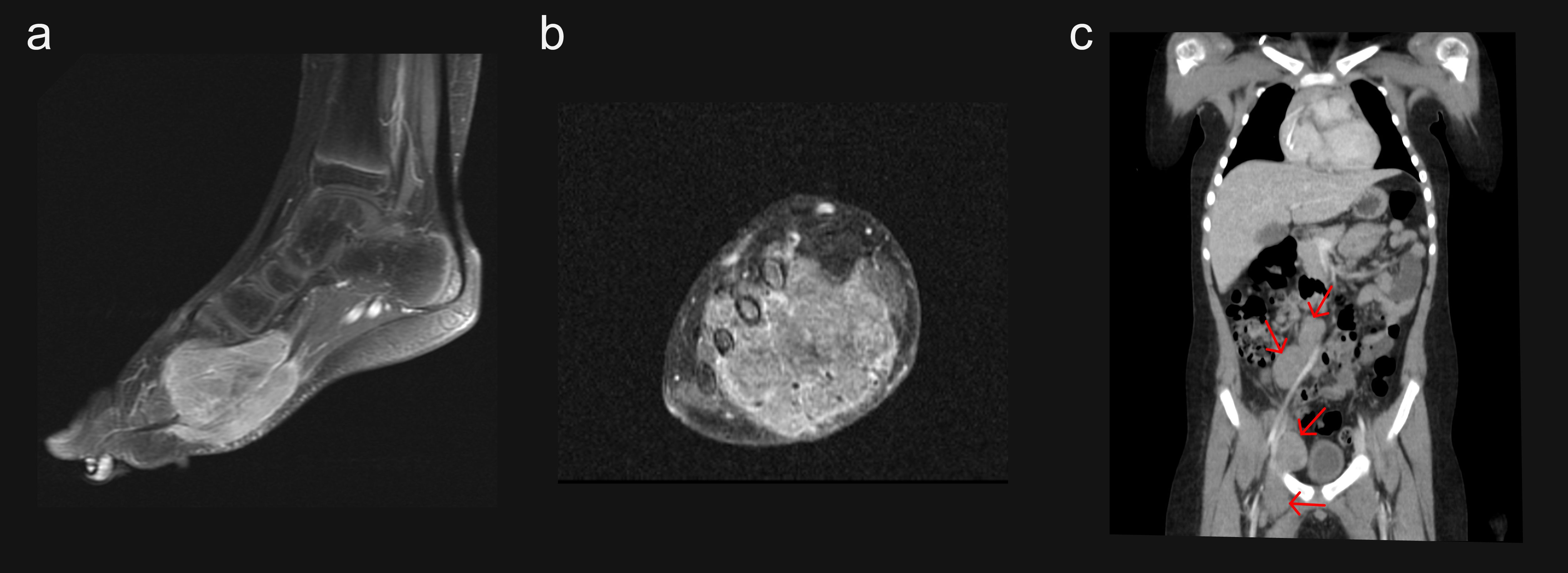 MRI and CT scan images in a series: (a) a sagittal view of a foot, (b) an axial view of a soft tissue structure, and (c) a coronal abdominal view with arrows indicating specific areas of interest.