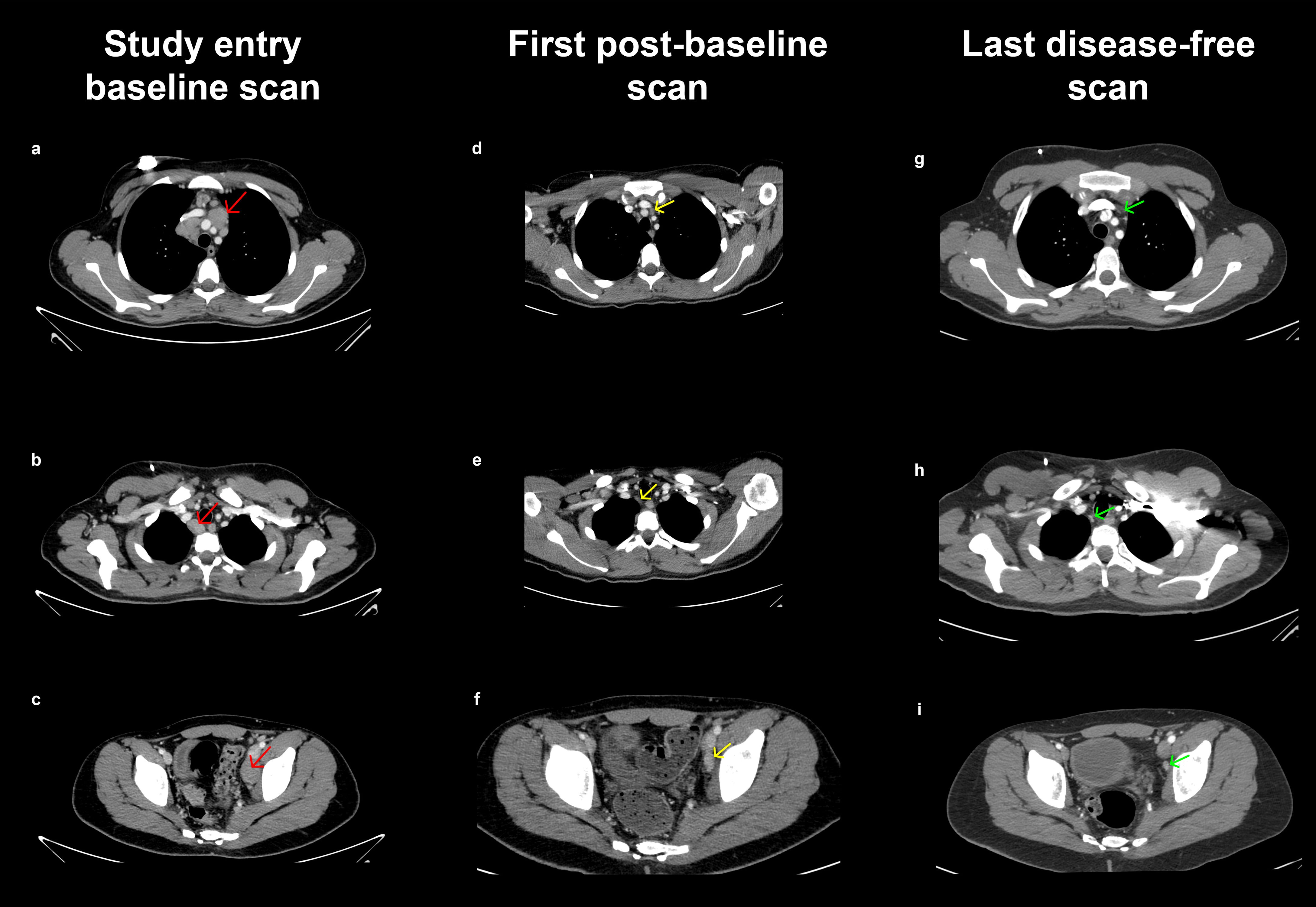 CT scans arranged in three columns. The first column shows the baseline scans with red arrows indicating abnormalities. The second column presents post-baseline scans with yellow arrows, indicating changes. The third column features disease-free scans with green arrows showing normalized areas. Each row corresponds to different body sections: upper chest (a, d, g), lower chest (b, e, h), and pelvis (c, f, i).