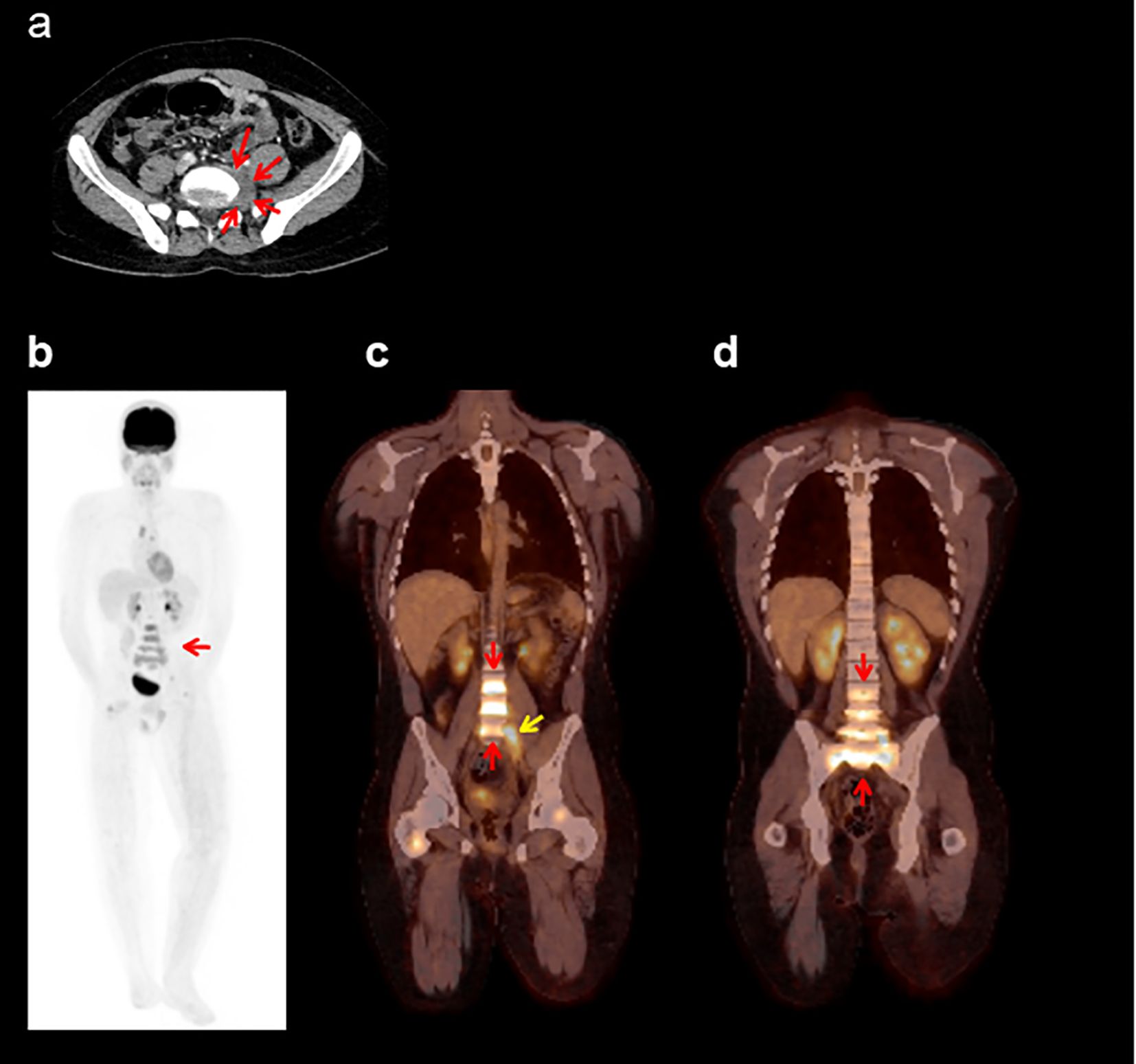 CT and PET scan images displaying various cross-sections of a body. Panel (a) shows a CT cross-section with red arrows indicating specific areas. Panel (b) is a full-body PET scan with a red arrow pointing to a highlighted region. Panel (c) and panel (d) are coronal PET/CT fusion images showing red and yellow arrows identifying areas of interest along the spine and abdomen.