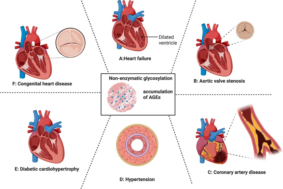 Diagram illustrating cardiovascular diseases linked to non-enzymatic glycosylation and accumulation of AGEs, including heart failure, aortic valve stenosis, coronary artery disease, hypertension, diabetic cardiomyopathy, and congenital heart disease, with labeled heart illustrations and details such as a dilated ventricle and blocked arteries.