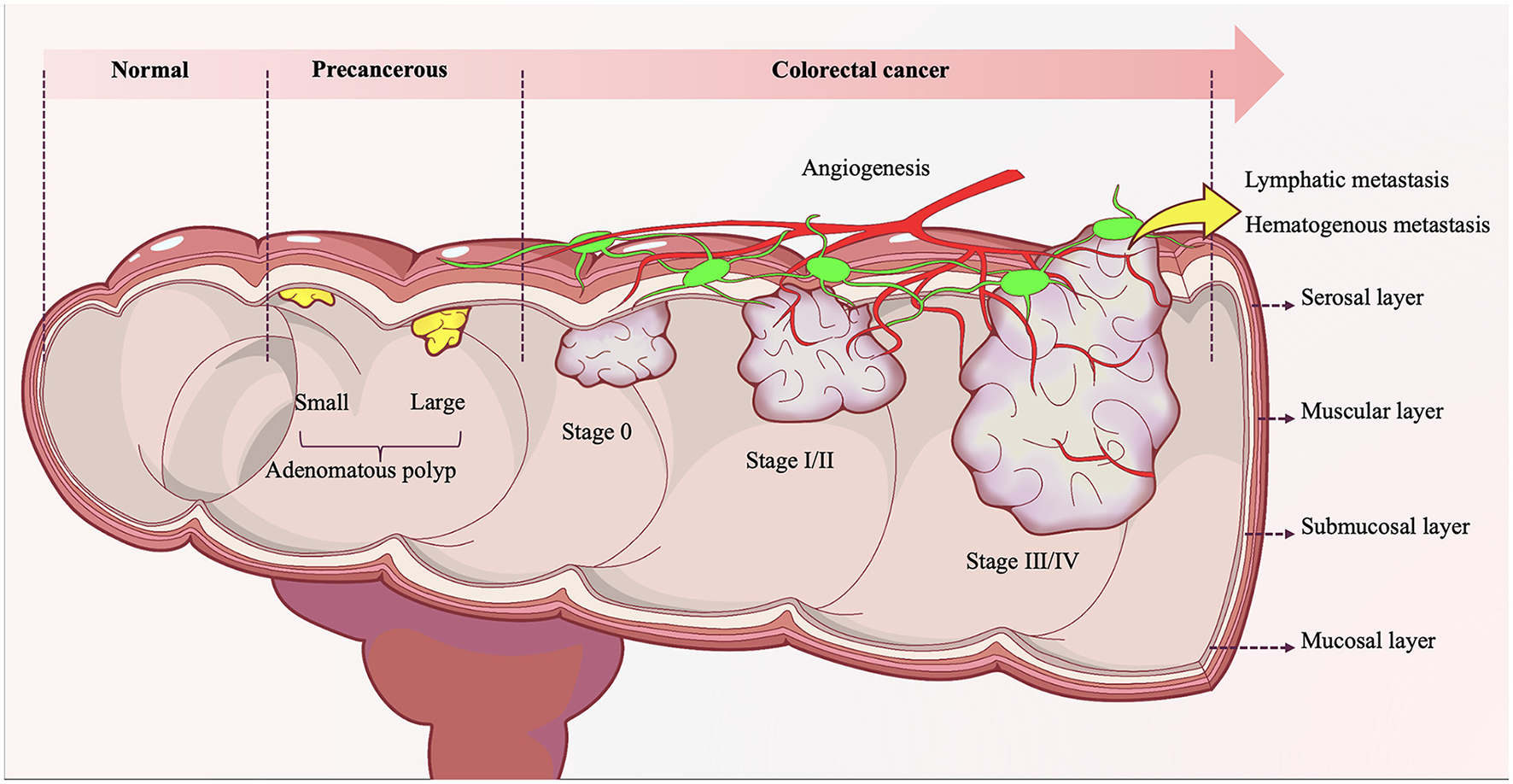 Illustration showing the progression from normal colon tissue through precancerous adenomatous polyps to colorectal cancer stages 0, I/II, and III/IV. Different layers of the colon, including mucosal, submucosal, muscular, and serosal, are labeled on the right. Arrows indicate lymphatic and hematogenous metastasis, with angiogenesis depicted in cancer stages.