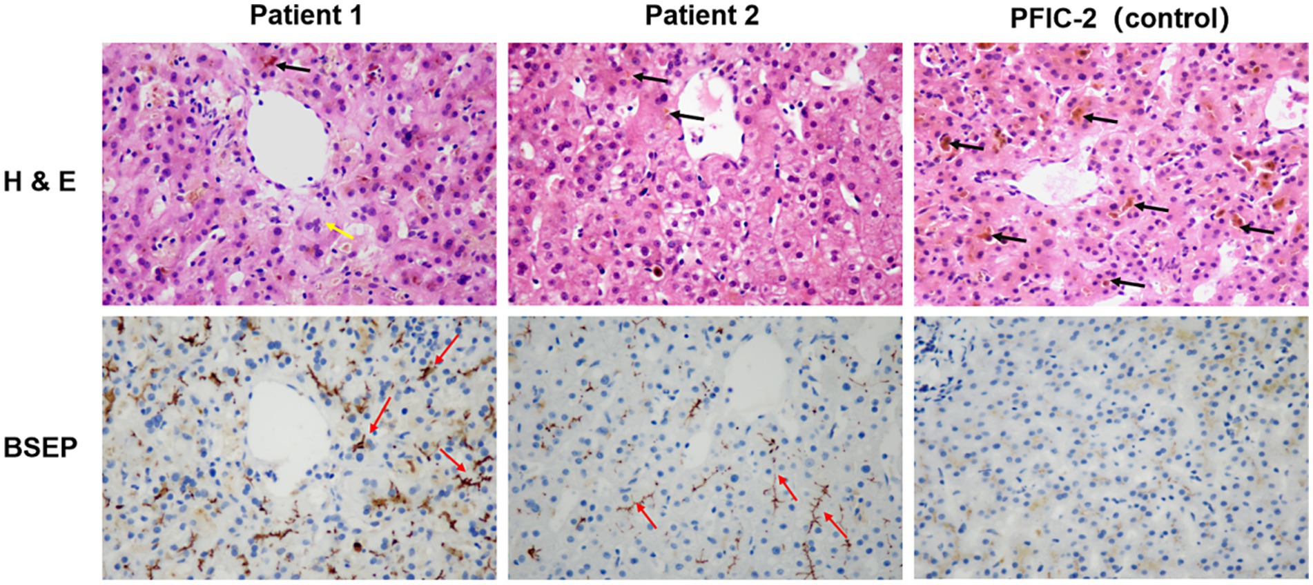Histological images of liver sections from two patients and one control. The top row shows H&E stained sections, with black arrows indicating cellular structures. The bottom row shows BSEP stained sections, with red arrows highlighting bile salt export pump expression. Differences in staining patterns are visible across Patient 1, Patient 2, and PFIC-2 (control).