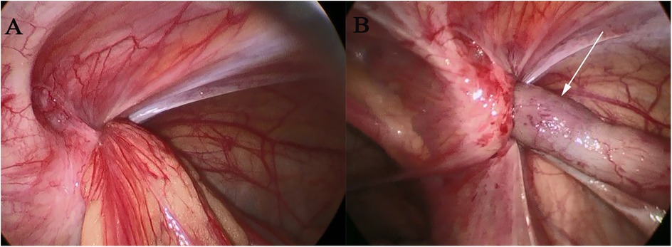 Endoscopic images labeled A and B showing the abdominal cavity. Image A displays the intestine with visible blood vessels and tissue. Image B highlights a close-up of the intestine with an arrow pointing to a specific area, indicating a notable feature or condition.