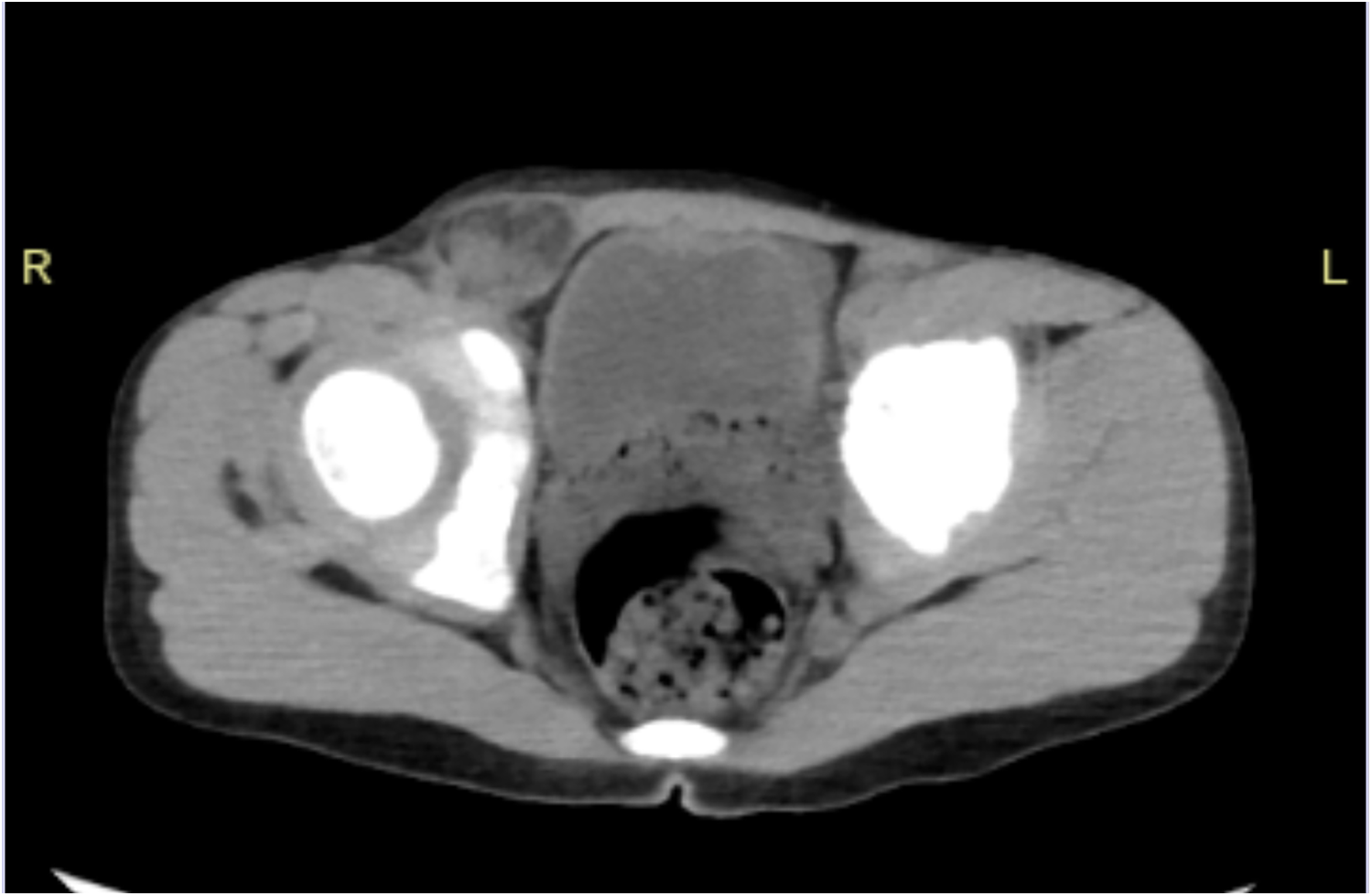 CT scan of the pelvic region in the axial plane, showing various tissues and structures in different shades of gray and white. The right and left labels indicate orientation.