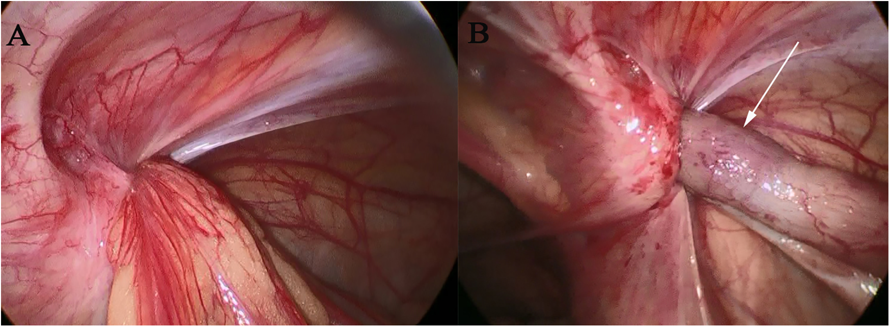 Endoscopic images labeled A and B showing the abdominal cavity. Image A displays the intestine with visible blood vessels and tissue. Image B highlights a close-up of the intestine with an arrow pointing to a specific area, indicating a notable feature or condition.