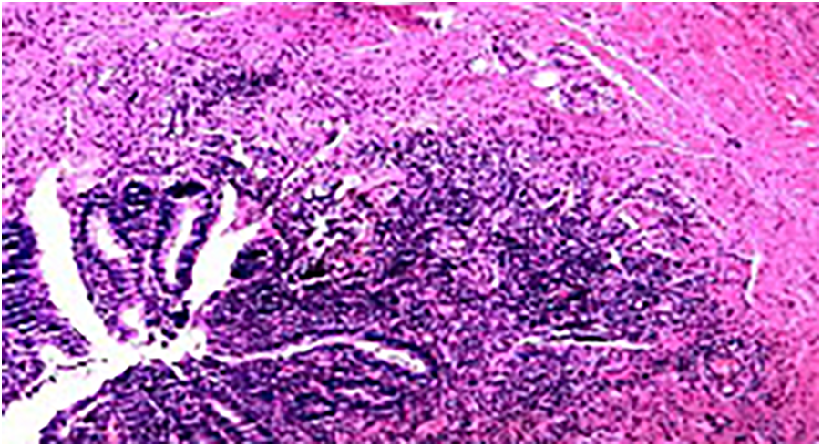 Microscopic view of tissue sample stained for examination, showing varying shades of pink and purple with visible structures and cells, typical of histological analysis.