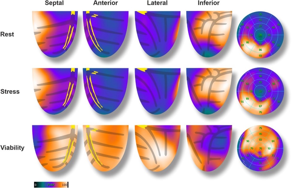 Color-coded medical imaging depicting four views: septal, anterior, lateral, and inferior, during rest, stress, and viability states. The images show color variations from blue to orange, indicating different levels, with a color scale from zero to one hundred. The rightmost column features circular charts with numbered sections reflecting the same color scale.