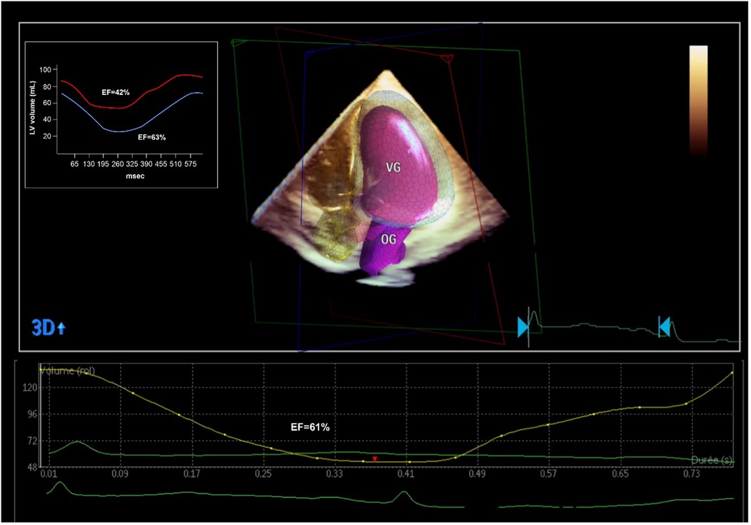 3D echocardiography visualization showing ventricular geometry with labeled sections VG and OG. A graph indicates left ventricular volume over time in milliseconds, highlighting ejection fractions of 42 percent and 63 percent. A separate line graph at the bottom tracks volume changes, with an ejection fraction of 61 percent indicated.