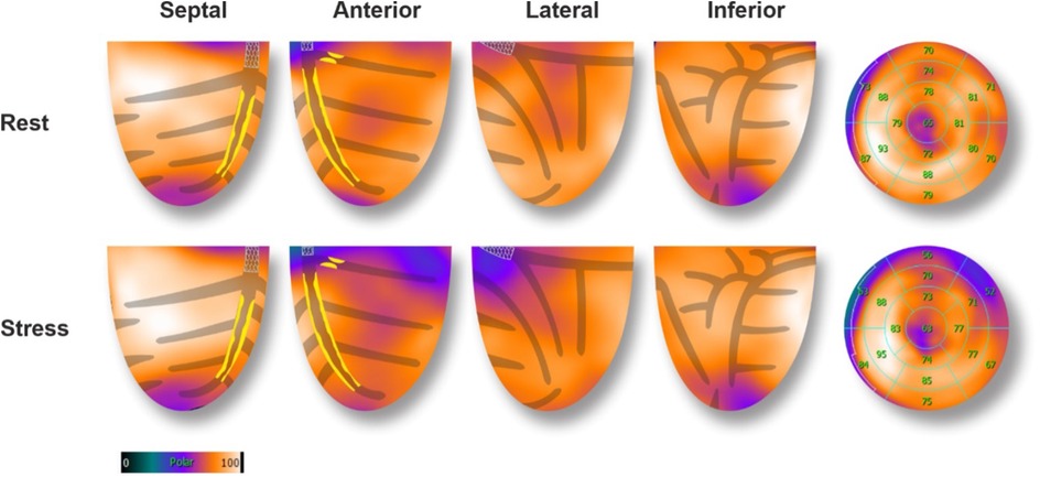 Comparison of myocardial perfusion images during rest and stress in four sections: septal, anterior, lateral, and inferior. Each section shows variations in color from purple to orange, indicating different perfusion levels. A circular chart displays numeric values within concentric rings, providing quantitative data. A color bar indicates perfusion from zero in blue to one hundred in orange.
