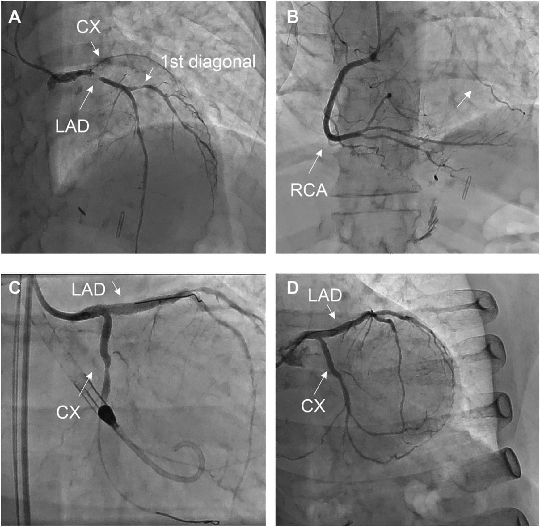 Panel A shows coronary angiography identifying the left anterior descending (LAD) artery, circumflex (CX) artery, and first diagonal branch. Panel B shows the right coronary artery (RCA). Panel C highlights the LAD and CX arteries. Panel D depicts the LAD and CX arteries from another angle.