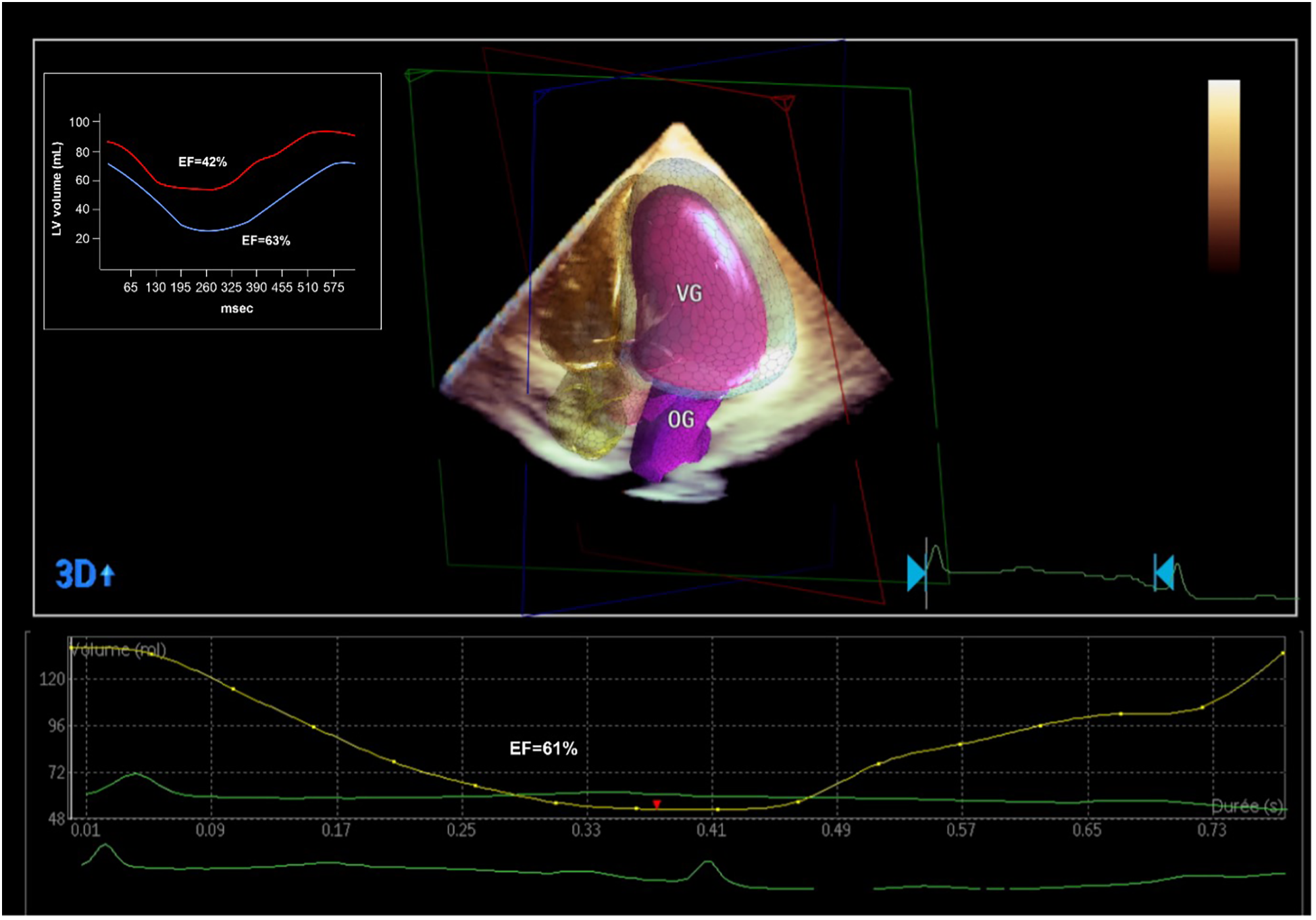 3D echocardiography visualization showing ventricular geometry with labeled sections VG and OG. A graph indicates left ventricular volume over time in milliseconds, highlighting ejection fractions of 42 percent and 63 percent. A separate line graph at the bottom tracks volume changes, with an ejection fraction of 61 percent indicated.