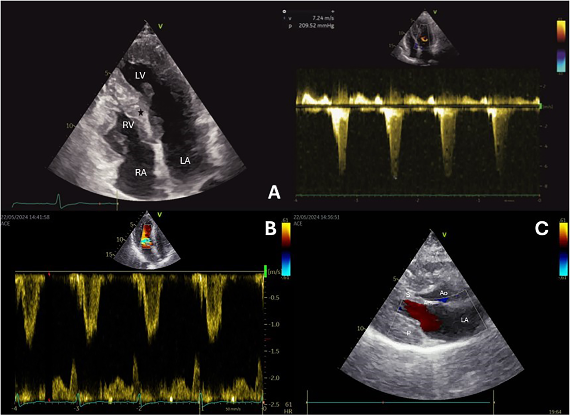 Three-panel echocardiographic image. Panel A: 2D echocardiogram showing the left and right ventricles and atria. Panel B: Doppler waveform with color flow indicating blood velocity. Panel C: 2D apical four-chamber and parasternal long-axis views. Color Doppler shows forward flow across the mitral valve, and continuous-wave (CW) Doppler signal in the left ventricular outflow tract.