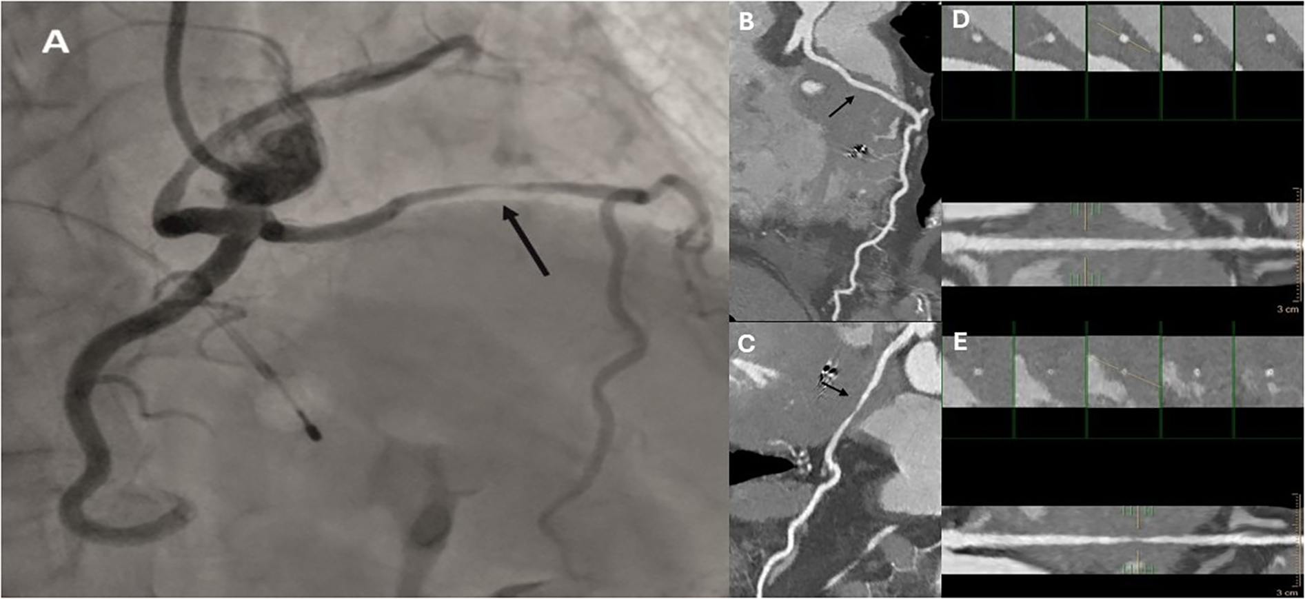 Composite medical imaging showing different views of arteries. Panel A depicts an angiogram with a highlighted artery. Panels B and C show CT scans with arrows indicating specific areas. Panels D and E display series recordings of artery segments with measurement markers.