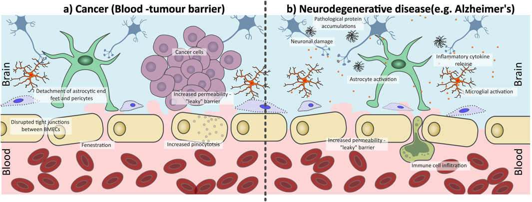 Illustration comparing the blood-brain barrier in cancer (left) and neurodegenerative diseases like Alzheimer's (right). The cancer section shows cancer cells, disrupted tight junctions, detachment of astrocytic structures, and increased permeability. The neurodegenerative section depicts astrocyte activation, pathological protein accumulations, neuronal damage, microglial activation, inflammatory cytokine release, immune cell infiltration, and a leaky barrier. Both sections highlight increased permeability in the blood vessels.