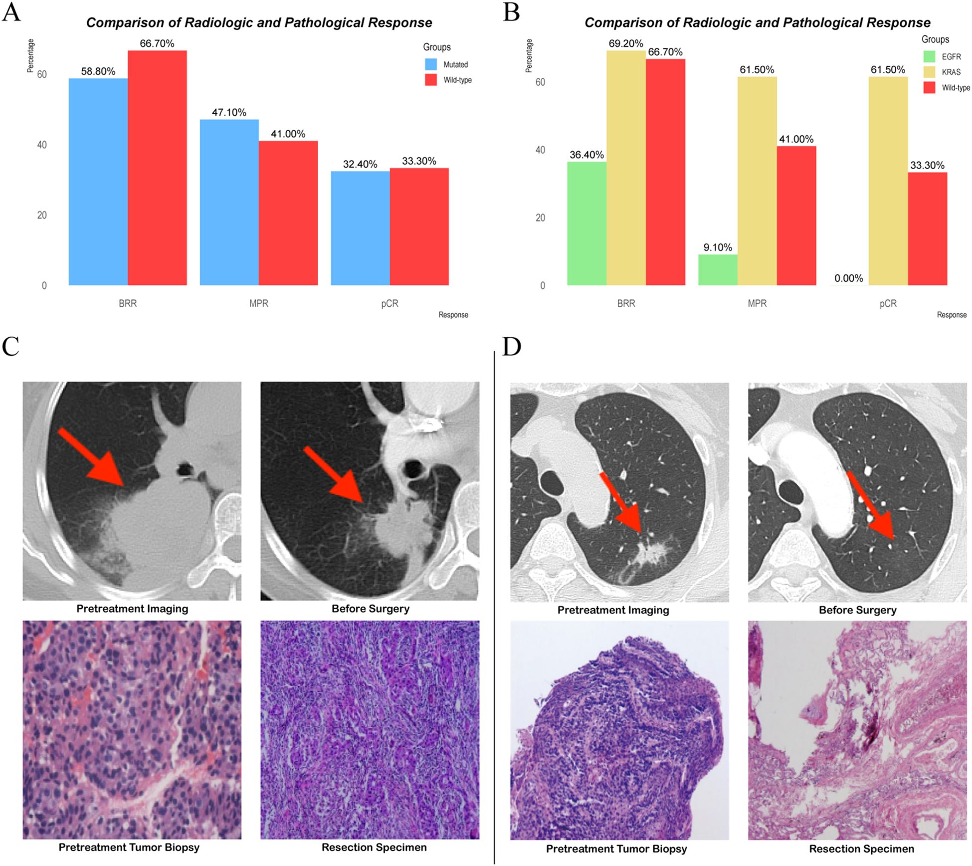 Bar charts compare radiologic and pathological responses between different groups. Two sets of medical images show pre-treatment and pre-surgery scans with red arrows indicating tumor locations, and histological images showing pre-treatment and resection specimens.