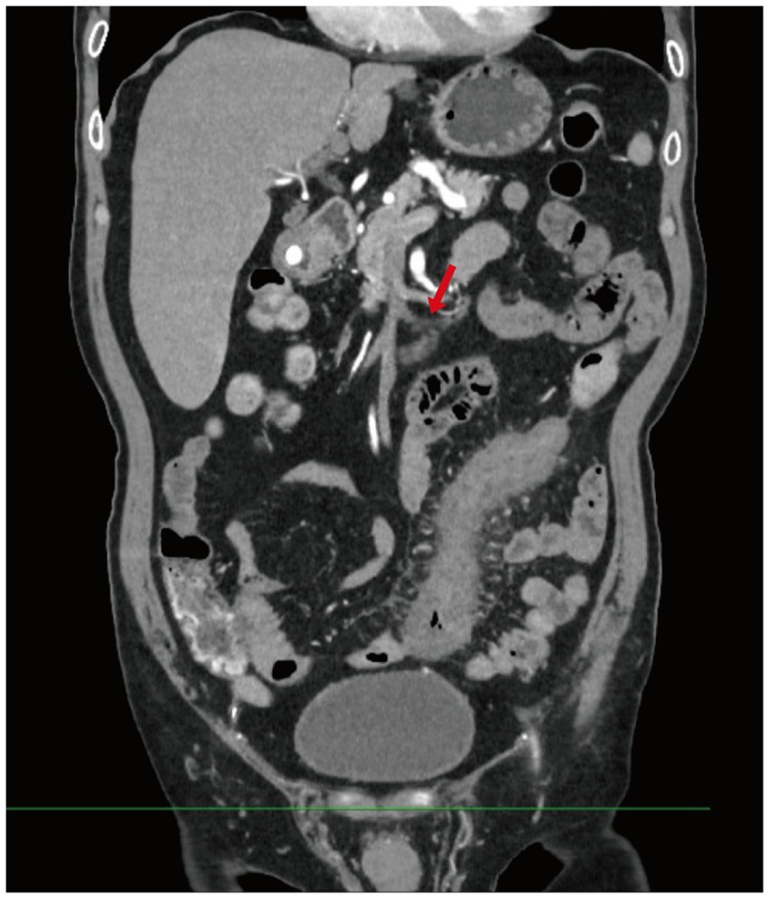 Coronal CT scan of the abdomen highlighting gastrointestinal structures with a red arrow pointing to an area of interest in the upper right section, possibly indicating an abnormal finding.