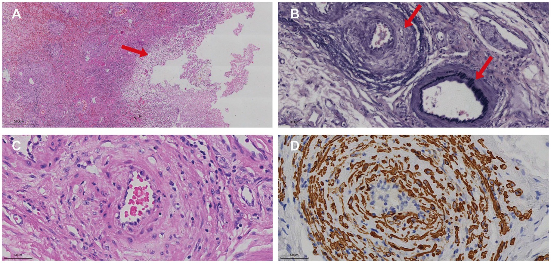 Four-panel histological images depict tissue samples. Panel A shows tissue stained with varying pink and purple areas, with a red arrow indicating cellular clusters. Panel B displays a close-up of spiral structures with two red arrows highlighting specific areas. Panel C reveals a cluster of cells surrounding a central lumen. Panel D shows a spiral structure with cells stained brown, indicating protein presence.
