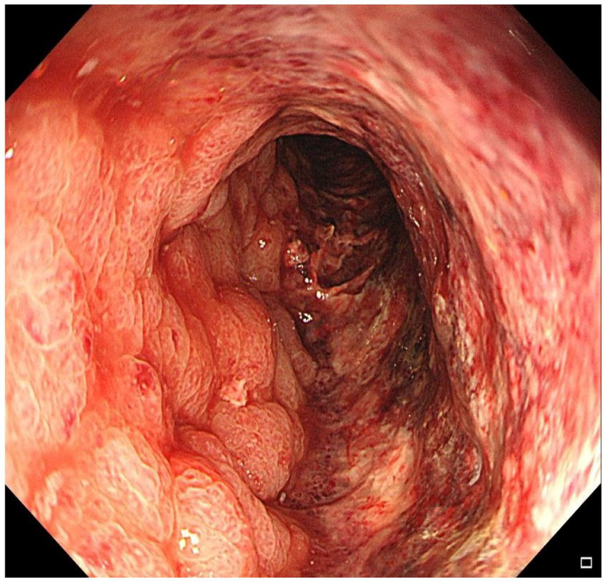Endoscopic image of the colon showing inflamed and swollen tissue with ulceration. The intestinal wall appears reddened with visible layers and grooves, indicating potential colitis.