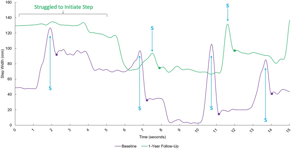 Line graph comparing step width over time for baseline and one-year follow-up. The baseline (purple line) shows higher peaks, indicating struggle to initiate steps around two, seven, and eleven seconds, marked by \