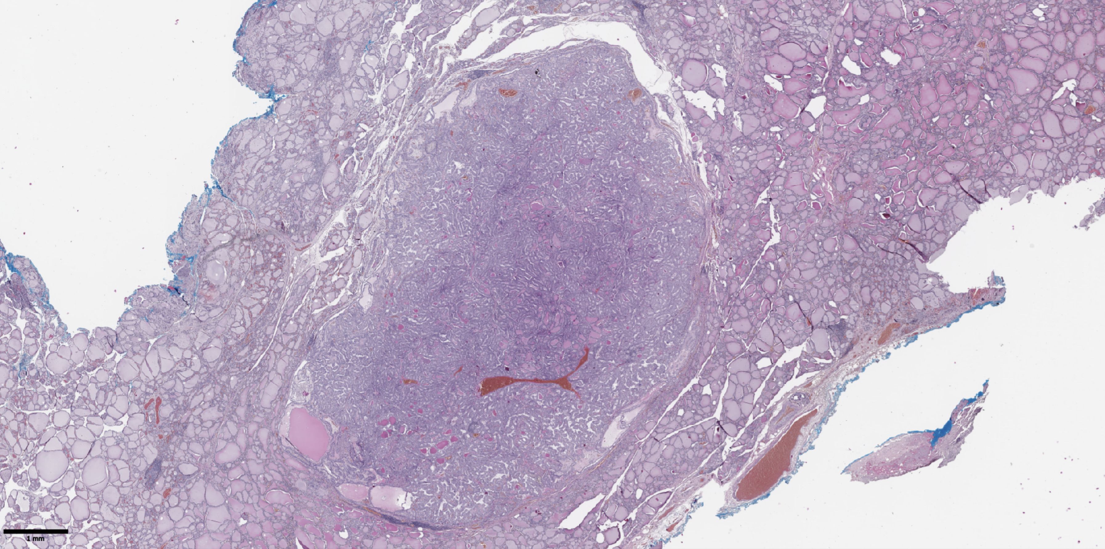 Microscopic image of tissue showing a dense circular nodule in the center, stained in shades of purple and pink. Surrounding areas have fibrous structures with various cell shapes and sizes. Scale bar indicates a length of 1 millimeter.