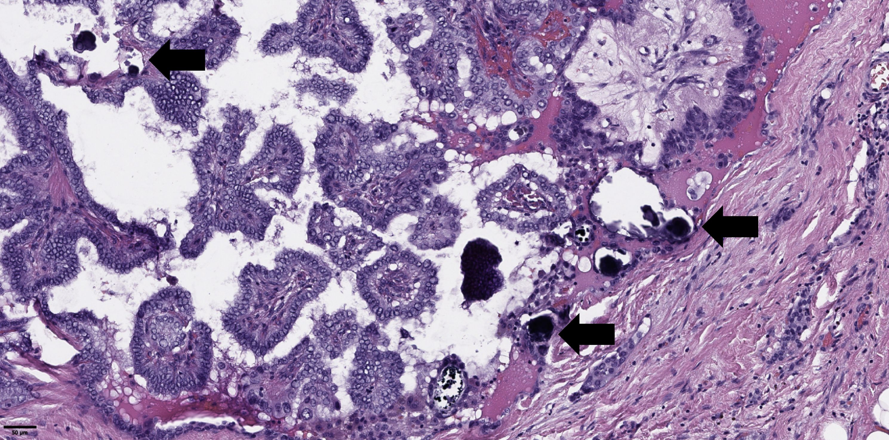 Microscopic image shows dense clusters of dark purple cells, irregularly shaped and tightly packed. Light pink tissue surrounds them, with black arrows indicating certain cell areas. Scale bar reads fifty micrometers.